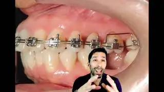 Molar Intrusion with Double Slot Bracket