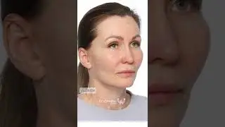 Such an amazing result of recovery after Anti-aging surgeries in Korea! #antiaging  #facelift