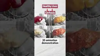 3d #animation demonstration of #liver #fattyliver #livercancer #obesi#weightloss #wls