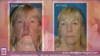 QuickLift&trade; vs. Traditional Facelift - Alexander Cosmetic Surgery in San Diego