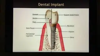 Endo 101 - Difference between a root and an implant