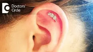 How to manage an infected cartilage of helix post Ear Piercing? - Dr. Harihara Murthy