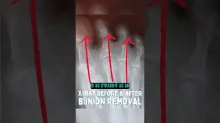 Bunion removal before and after x-ray! 😱  #bunionpainrelief #bunion #bunioncorrection