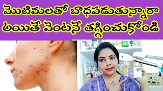 Seebuck Acne control cream review- pimples control cream in Telugu-acne control by Apple beauty
