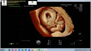 HOLOPROSENCEPHAL - KELAINAN BAWAAN BERAT KEPALA - JANIN TRIPLOID/TRISOMY (Dr Wiku Andonotopo)