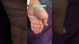 Clammy hands- overactive sweat glands (hyperhidrosis)