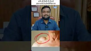 Best homeopathic medicines for cyst or tumors #skincare #alternativemedicine #health #naturalcure