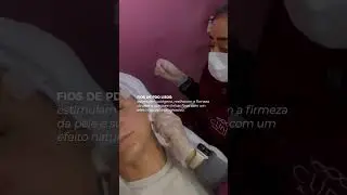 ✨ Fios de PDO: est&iacute;mulo de col&aacute;geno + efeito lifting imediato! ✨