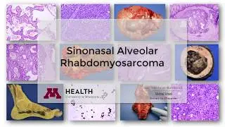 Alveolar Rhabdomyosarcoma