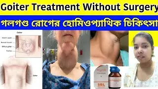 Goiter treatment without surgery |গলগন্ড রোগের হোমিওপ্যাথিক চিকিৎসা