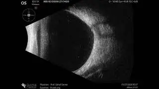 20 MHz Annular Ophthalmic Ultrasound ABSolu, Slight posterior staphyloma , 36948