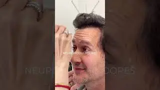 neuromoduladores, paciente ideal