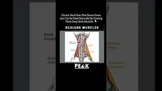 Chronic Neck Pain That Shoots Down Arm Can Be Fixed Naturally By Treating These Deep Neck Muscles ❗️