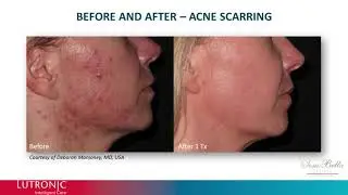 Genius Laser - before and after video