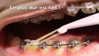 Mettre ses &eacute;lastiques inter-maxillaires en orthodontie