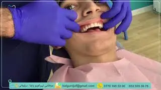 هۆڵیود سمایڵ Hollywood Smile