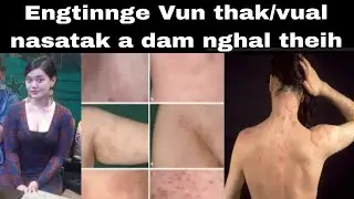 Engtinnge thak vual khat vek a dam nghal theih : Hetiang damdawi thatak hi ilo hre tawh em ?