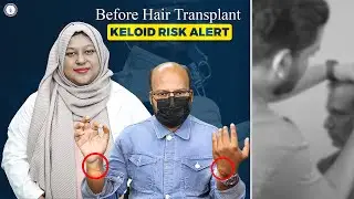 Before Hair Transplant, Watch This | Keloid Risk Alert ⚠️ | Bangladesh
