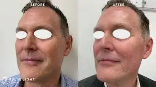 NON-SURGICAL FACELIFT - PROFOUND RF TREATMENT