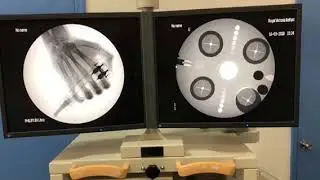 Philips Bv Libra Carm