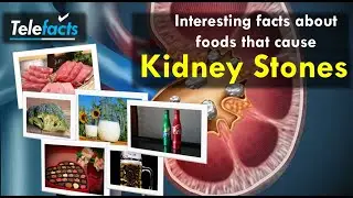Interesting facts about foods that cause kidney stones (Rhubarb, Nuts and Nut Butter, Peanuts&hellip;)