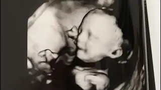 Trisomy Awareness Month