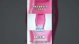八爪鱼术式优化后 一举两得 解决多重烦恼#医学科普 #产后恢复 #私密健康 #紧缩术 #宝妈必看