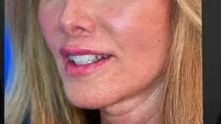 Dr. Renato Calabria Explains Customization With the Stem Cell Facelift