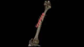 Reconstruccion 3D de humero con cx por fractura, tomografo GE ACT Revolution