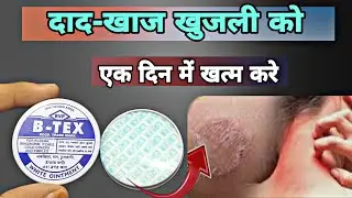 b tex ointment uses in hindi | skin infection solution | khujli ki dawa | Prince Azeemudsin