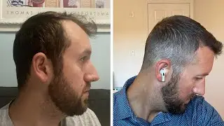 Day 150 Results - 5 Month FUE Hair Transplant - Fast Progress
