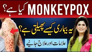 Monkeypox (Mpox): What Is It, How It Spreads, Symptoms, Rash Stages & Treatment | Dr. Fareeha Tariq