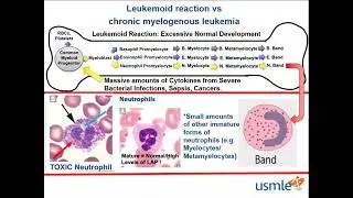 Leukemoid Reaction vs Chronic Myelogenous Leukemia