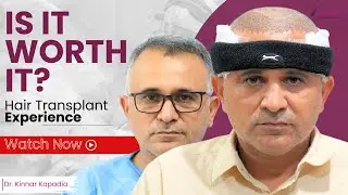 FUE Hair Transplant Experience in Ahmedabad | Real Results & Transparent Cost