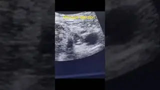 Ultrasound guided percutaneous thrombin injection for iatrogenic femoral artery pseudoaneurysm
