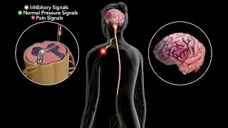 Fibromyalgia