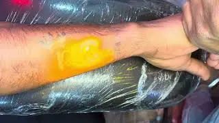 Tattoo Removal || Laser Treatment || No Scars || 💯% guarantee without any side effects plz subscribe