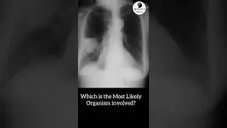 Which is the Most Likely organism involved with this Consolidation? #pulmonology #shorts #medicine
