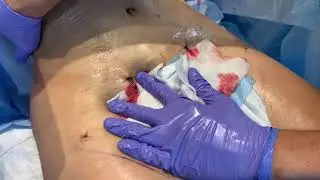 THIS MOMMY HAS A SNATCHED WASIT AND SIX PACK AFTER SUPERMODEL LIPOSUCTION AT 1 DAY | Dr. Jason Emer