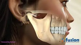 TMJ Occlusional Splint
