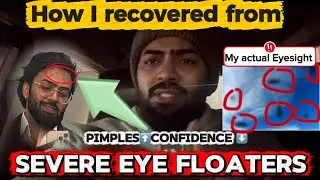Please don&rsquo;t take it lightly🚨 1 solution to Pimples & Eye Floaters | Must Watch‼️
