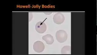Red Blood Cell Disorder -- Heinz bodies, Howell-jolly bodies, basophilic stippling & Reticulocytes