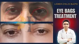 Lower Eyelid Blepharoplasty with Fat Grafting & CO2 Laser | Treatment for Severe Eye Bags