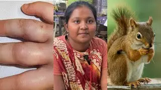 அணில் கடிச்சா இப்படியும் ஆகுமா @MRVS728