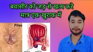 What is piles| Piles ke signs and Symptoms| cause| #Hemorrhoids| बवासीर के treatment| ilaj 