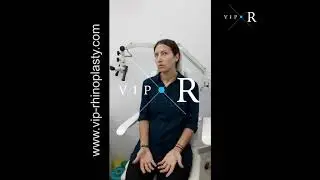 3 months after my Rhinoplasty Surgery: Post-Op recovery without pain. Nose Job. with dr. Mireas