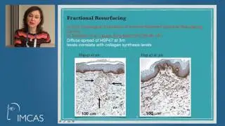 IMCAS Resurfacing 2017   where do we stand?