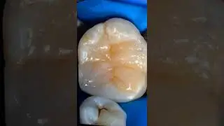 Posterior restoration (part 1)