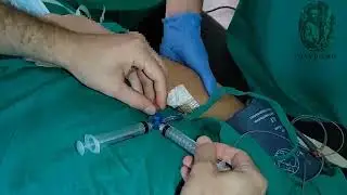 Prueba de microburbujas (soluci&oacute;n salina agitada)