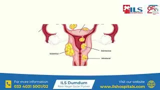 Watch Dr. Anuradha Roy, share key insights on fibroids in pregnancy | Expert Talk | ILS Hospitals